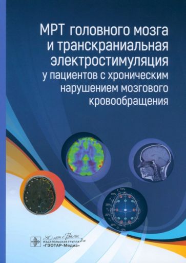 МРТ головного мозга и транскраниальная электростимуляц.у пациентов с хронич.нару