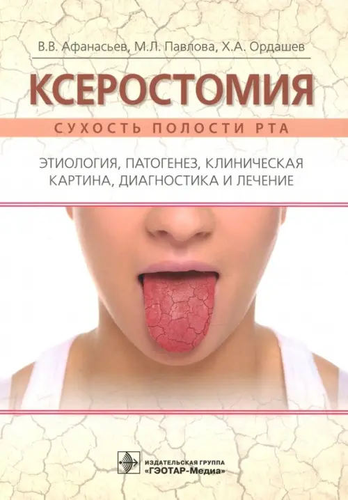 Ксеростомия. Сухость полости рта. Этиология, патогенез, клиническая картина, диагностика и лечение